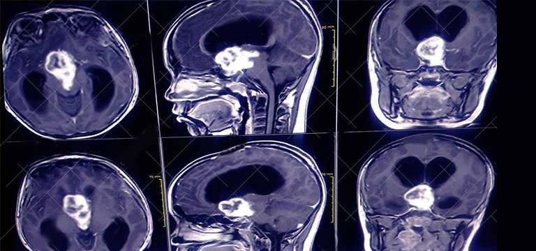 MRI Brain Orbit: Know more about Eye Imaging